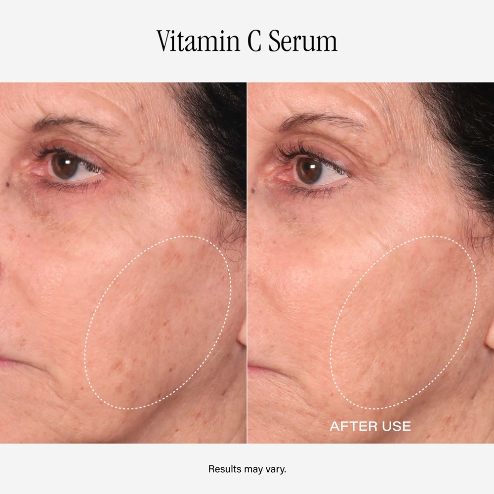 Before and after Vitamin C Serum, result 2