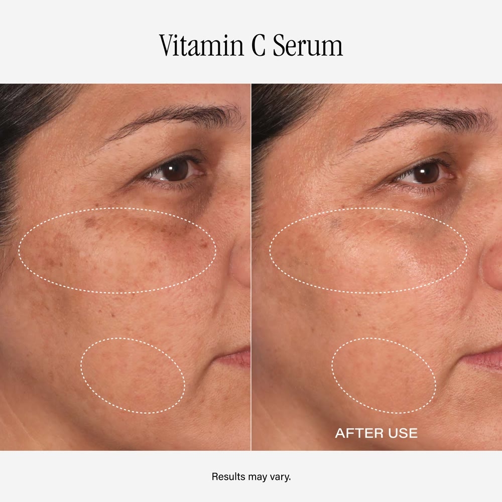 Before and after Vitamin C Serum, result 1