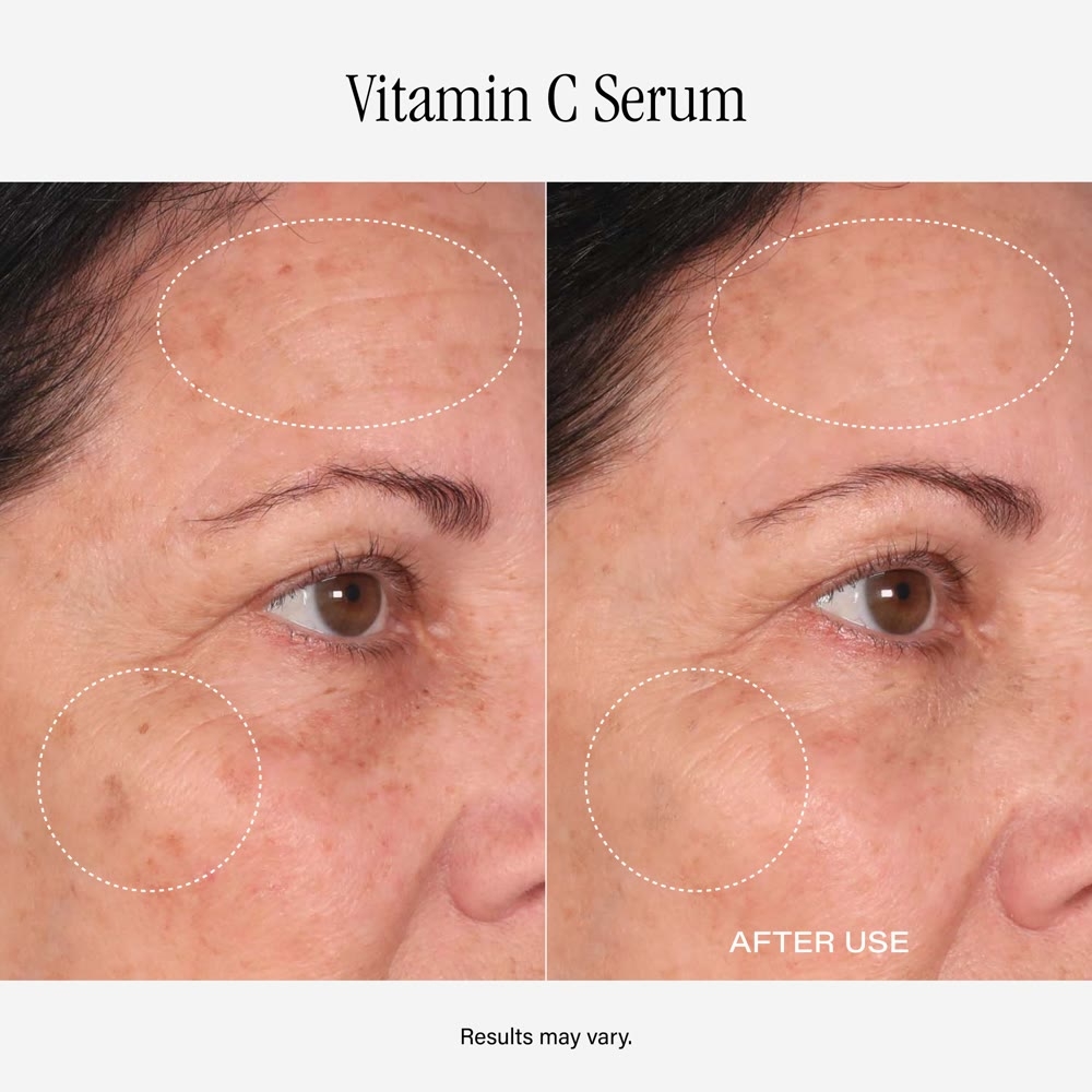Before and after Vitamin C Serum, result 3